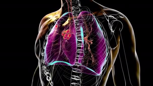 プライマリ肺結核 3Dアニメーションは ゴンホン複合体と中性リンパ腫を特徴としています 3Dイラスト — ストック動画