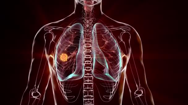 Människokropp Med Genomskinlig Hud Som Visar Lungcancer Animering — Stockvideo