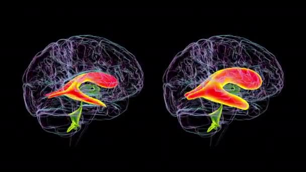 Hidrocefalia Aumentada Lado Direito Animação Ventrículos Laterais Esquerdos Normais Cérebro — Vídeo de Stock