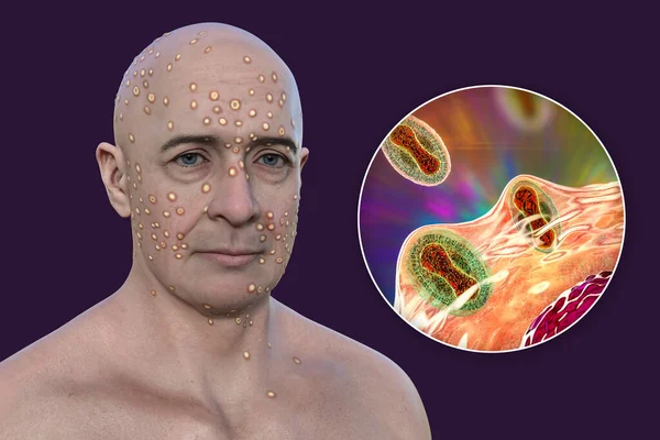 3D插图描绘了带有痘病毒 阿拉斯加痘病毒 猴痘等 皮疹的人 以及感染人类细胞的Poxviridae病毒的特写 — 图库照片