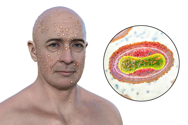 Illustrazione Raffigura Uomo Con Eruzione Cutanea Virus Del Vaiolo Vaiolo — Foto Stock