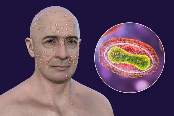 Illustration Depicts Man Rash Pox Viruses Smallpox Alaskapox Monkeypox Alongside — Stock Photo, Image