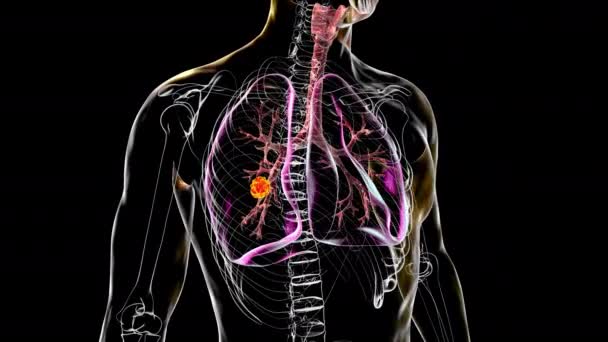 Ein Menschlicher Körper Mit Transparenter Haut Die Lungenkrebs Zeigt Animation — Stockvideo