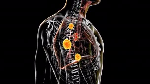 Akciğer Lezyonları Genişlemiş Bronşiyal Lenf Bezleriyle Pulmoner Blastomikoz Sebebi Mantar — Stok video