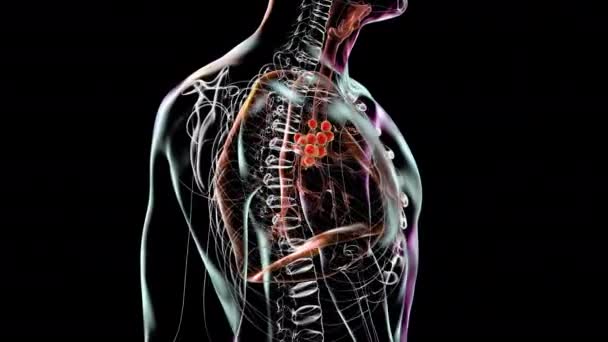 原发性肺结核病 以根群和纵隔淋巴结炎为特征的3D动画 — 图库视频影像