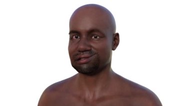 Afrikalı bir adamda yüz felci ve aynı sağlıklı adam, fotorealistik üç boyutlu animasyon yüz kaslarının bir tarafındaki asimetri ve düşüşü vurguluyor..
