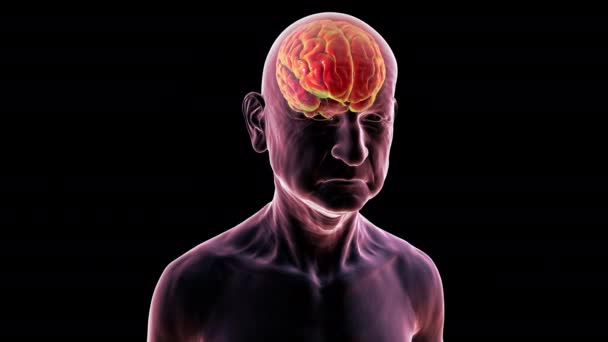 大脑突出的老年人 老年痴呆症 3D概念动画 显示老年人大脑功能逐渐受损 旋转360度 — 图库视频影像
