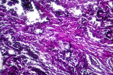 Mikroskop altında silikoz patolojisini gösteren akciğer dokusunun fotokopisi alveol ve fibroziste silis parçacığının biriktiğini gösteriyor..