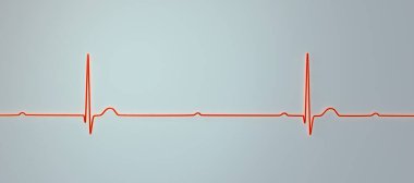 3. derece AV bloklu bir ECG görselleştirmesi, atriyal ve ventriküler ritimler arasında tam ayrışma gösteriyor.