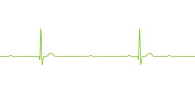 3. derece AV bloklu bir ECG görselleştirmesi, atriyal ve ventriküler ritimler arasında tam ayrışma gösteriyor.