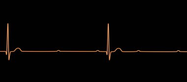 3. derece AV bloklu bir ECG görselleştirmesi, atriyal ve ventriküler ritimler arasında tam ayrışma gösteriyor.
