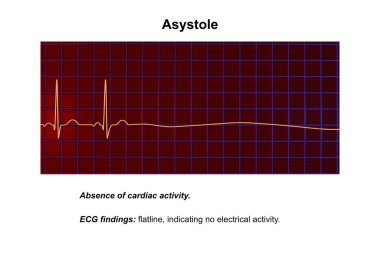 Asystole, a critical condition marked by the absence of any cardiac electrical activity. 3D illustration shows a flatline on the ECG, signifying a nonfunctioning heart with no pulse or heartbeat. clipart