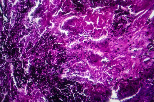 Photomicrograph Lung Tissue Depicting Silicosis Pathology Microscope Revealing Silica Particle — Stock Photo, Image