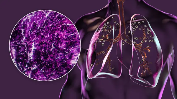 Nsan Vücudundaki Silikondan Etkilenen Akciğerleri Gösteren Boyutlu Illüstrasyon Işık Mikrografı — Stok fotoğraf
