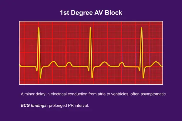 Illustration Ecg Displaying 1St Degree Block Cardiac Conduction Disorder — Stock Photo, Image