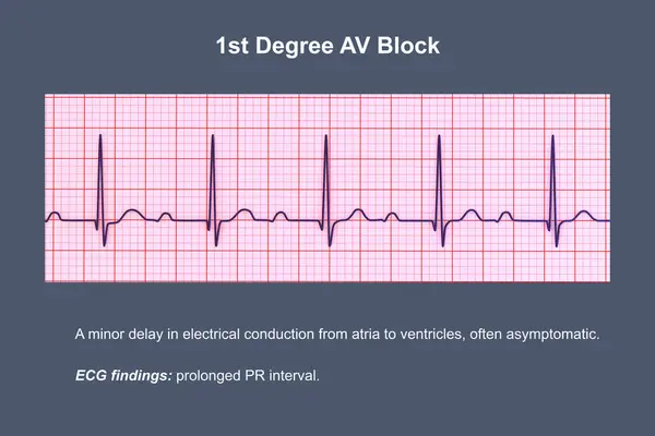 Illustration Ecg Displaying 1St Degree Block Cardiac Conduction Disorder — Stock Photo, Image