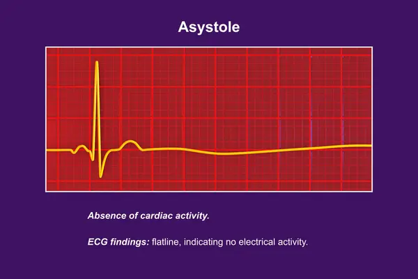 Asystole, a critical condition marked by the absence of any cardiac electrical activity. 3D illustration shows a flatline on the ECG, signifying a nonfunctioning heart with no pulse or heartbeat.