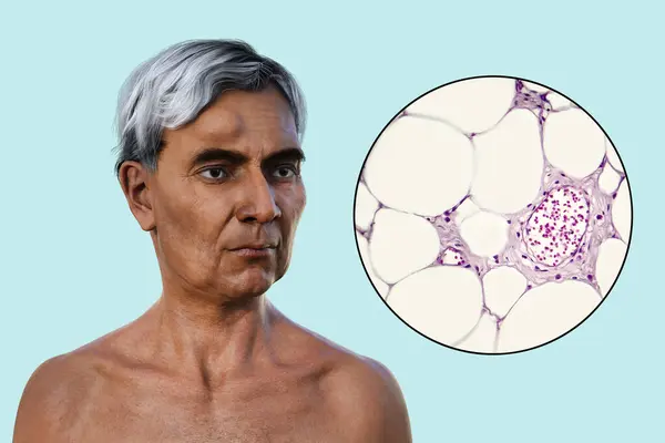 Ilustración Del Lipoma Frente Hombre Micrografía Ligera Adipocitos Las Células —  Fotos de Stock