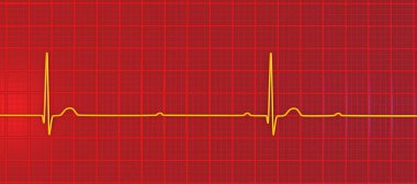 3. derece AV bloklu bir ECG görselleştirmesi, atriyal ve ventriküler ritimler arasında tam ayrışma gösteriyor.
