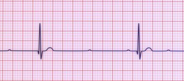 3. derece AV bloklu bir ECG görselleştirmesi, atriyal ve ventriküler ritimler arasında tam ayrışma gösteriyor.