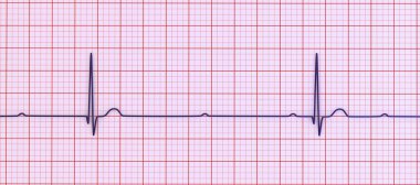 3D illustration visualizing an ECG with 3rd degree AV block, showing complete dissociation between atrial and ventricular rhythms. clipart