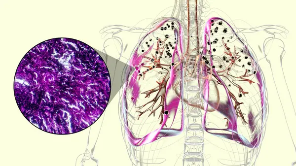Ilustración Micrografía Luz Que Representa Los Pulmones Afectados Por Silicosis —  Fotos de Stock