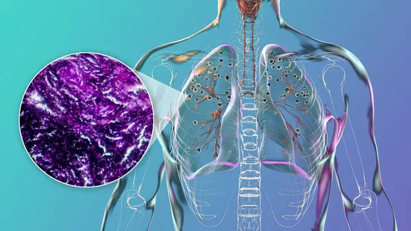 Ilustracja Mikrograf Świetlny Przedstawiający Płuca Dotknięte Silikozą Organizmie Człowieka Ujawniając — Zdjęcie stockowe