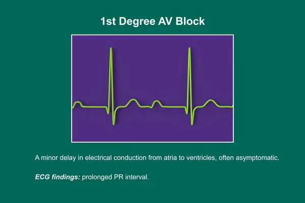 1級Avブロックを表示するEcgの3Dイラスト 心臓伝導障害 — ストック写真