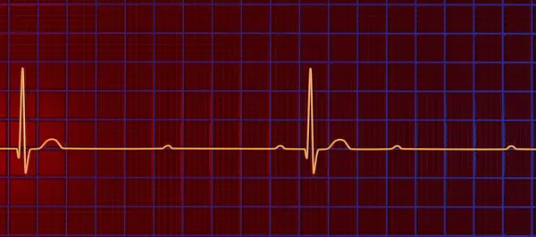3次元AvブロックでEcgを可視化した3Dイラストで 外来リズムと心臓リズムの完全な解離を示します — ストック写真