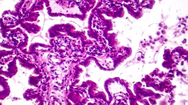 Αδενοκαρκίνωμα Των Πνευμόνων Ελαφρύ Μικροσκόπιο Υλικό Που Απεικονίζει Κακοήθη Αδενικά — Αρχείο Βίντεο