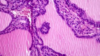 Toksik guatr histopatolojisi, hafif mikrograf görüntüleri tiroid foliküler hücrelerin hipertrofini, artan damar tıkanıklığını ve kolloid tükenmesini gösteriyor..