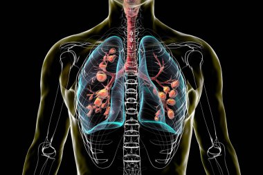 Kistik fibrozisten etkilenen akciğerler, yoğun mukus üretimine neden olan genetik bir bozukluk. 3 boyutlu illüstrasyon, mukus birikimi ve iltihaplanmasına bağlı bronşların genişlediğini gösteriyor..