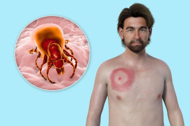 A man with erythema migrans, the characteristic rash of Lyme disease caused by Borrelia burgdorferi. The 3D illustration depicts the skin lesion, a close-up view of a tick vector, and Borrelia bacteria. clipart