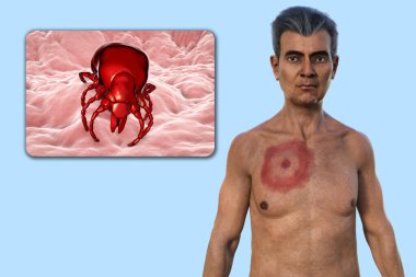 A man with erythema migrans, the characteristic rash of Lyme disease caused by Borrelia burgdorferi. The 3D illustration depicts the skin lesion, and a close-up view of a tick vector. clipart