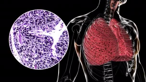 Ein Menschlicher Körper Der Raucherlungen Enthüllt Animationen Und Leichtes Mikrographenmaterial — Stockvideo