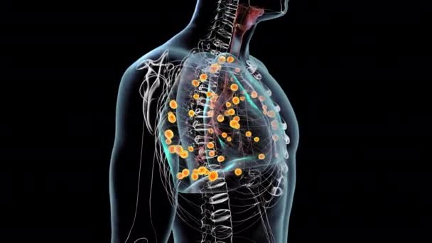 Akciğer Histoplazmozu Histoplasma Kapsülünün Sebep Olduğu Bir Mantar Enfeksiyonu Boyutlu — Stok video