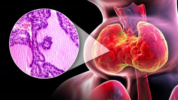 Animation Une Personne Atteinte Hypertrophie Glande Thyroïde Accompagnée Une Micrographie — Video