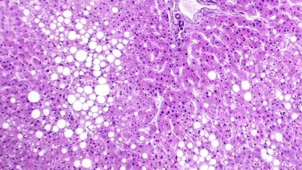 肝臓の病気として知られている肝臓細胞の脂肪蓄積を明らかにする肝臓の光学顕微鏡映像 — ストック動画