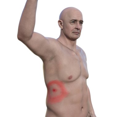 A man with erythema migrans, a characteristic rash of Lyme disease caused by Borrelia burgdorferi. 3D illustration depicts skin lesion progression. clipart