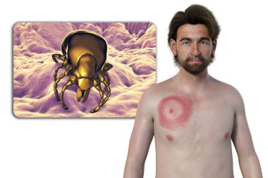 A man with erythema migrans, the characteristic rash of Lyme disease caused by Borrelia burgdorferi. The 3D illustration depicts the skin lesion, a close-up view of a tick vector, and Borrelia bacteria. clipart