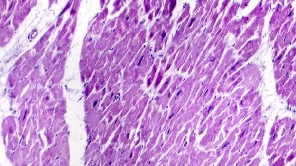 Herzhypertrophie Helle Mikrographie Aufnahmen Die Hypertrophisches Myokard Mit Dicken Muskelfasern — Stockvideo