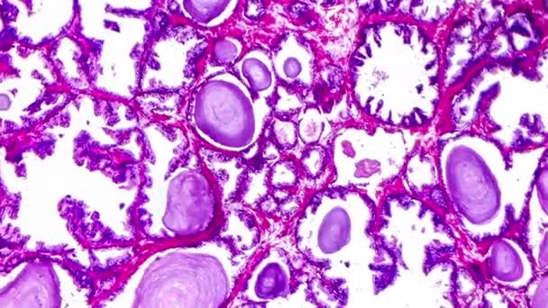 Goedaardige Prostaathyperplasie Micrografiebeelden Die Verwijde Klieren Papillaire Projecties Onthullen Klieren — Stockvideo