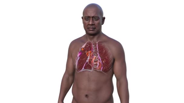 Primary Lung Tuberculosis Man Ghon Complex Animation Showing Pulmonary Lesion — Stock Video