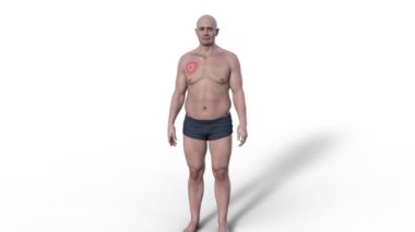Migreni olan bir adam. Borrelia Robdorferi 'nin sebep olduğu Lyme hastalığının tipik bir döküntüsü. 3 boyutlu animasyon..