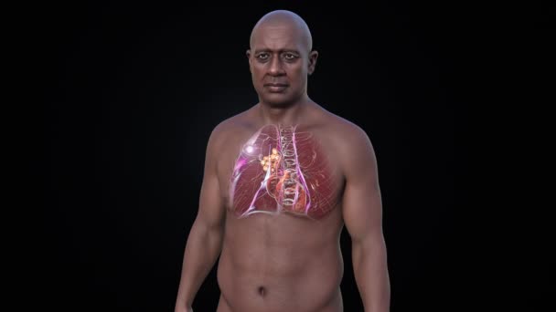 Tuberculosis Pulmonar Primaria Hombre Con Complejo Ranke Animación Que Muestra — Vídeos de Stock