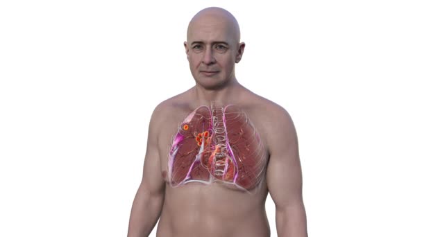 Первинний Туберкульоз Легень Чоловіка Комплексом Гонта Анімація Показує Пошкодження Легень — стокове відео
