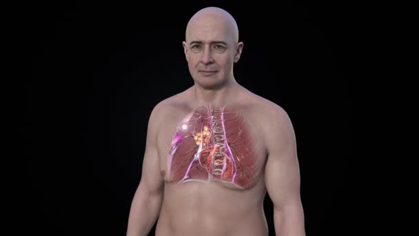 Ranke复合体男性原发肺结核3D动画显示肺病变及纵隔淋巴结炎合并钙化 — 图库视频影像