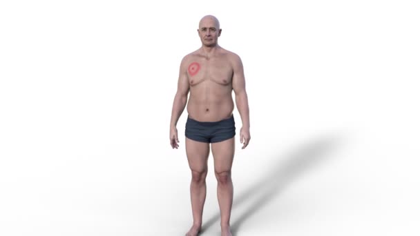 エリスマ移民の男性 ボレリア バーグドルフェリによるライム病の特徴的な発疹 3Dアニメーション — ストック動画