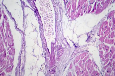 Mikroskop altında büyümüş ve kalınlaşmış kalp kası liflerini gösteren bir kardiyak hipertropi fotoğrafı..