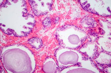 İyi huylu protez hiperplazisinin histolojik özelliklerini gösteren bir fotoğraf. Glandüler ve stromal bileşenlerin çoğalması ile birlikte büyümüş prostat bezi..